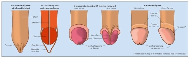 frenulotomie penis